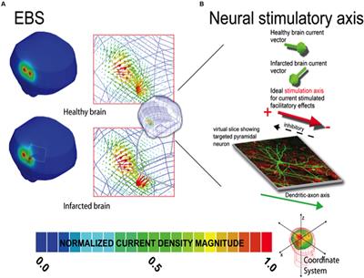 Motor Cortex Neurostimulation Technologies for Chronic Post-stroke Pain: Implications of Tissue Damage on Stimulation Currents